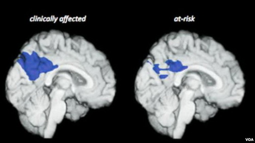 นักวิจัย Columbia ระบุชนิดของโปรตีนที่อาจเป็นต้นเหตุของโรค Alzheimer