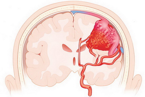 เส้นเลือดในสมองแตก.. สาเหตุและการป้องกัน