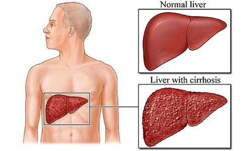 มะเร็งตับ พบได้มากเป็นอันดับหนึ่งในผู้ชาย