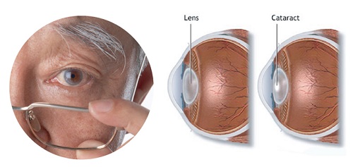 รู้จักกับเลนส์แก้วตาเทียม เพื่อการรักษาโรคต้อกระจก