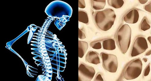 7 วิธีป้องกันกระดูกพรุนเมื่อเข้าสู่วัยชรา