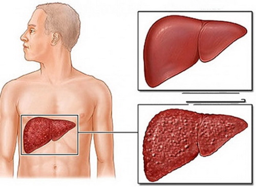 ตับแข็งไม่ได้เกิดจากการกินเหล้าเท่านั้น